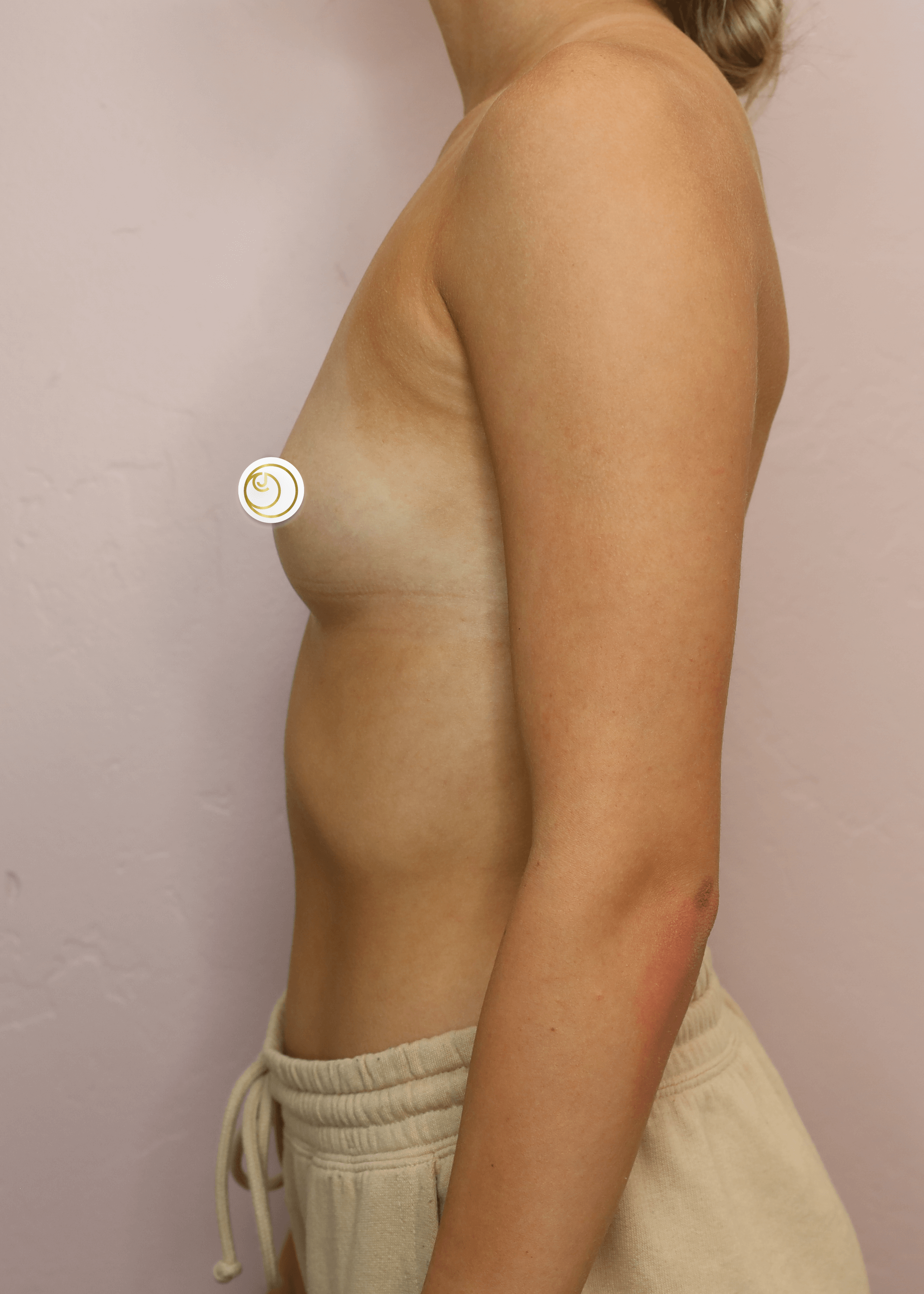 Breast Augmentation (Side) Before