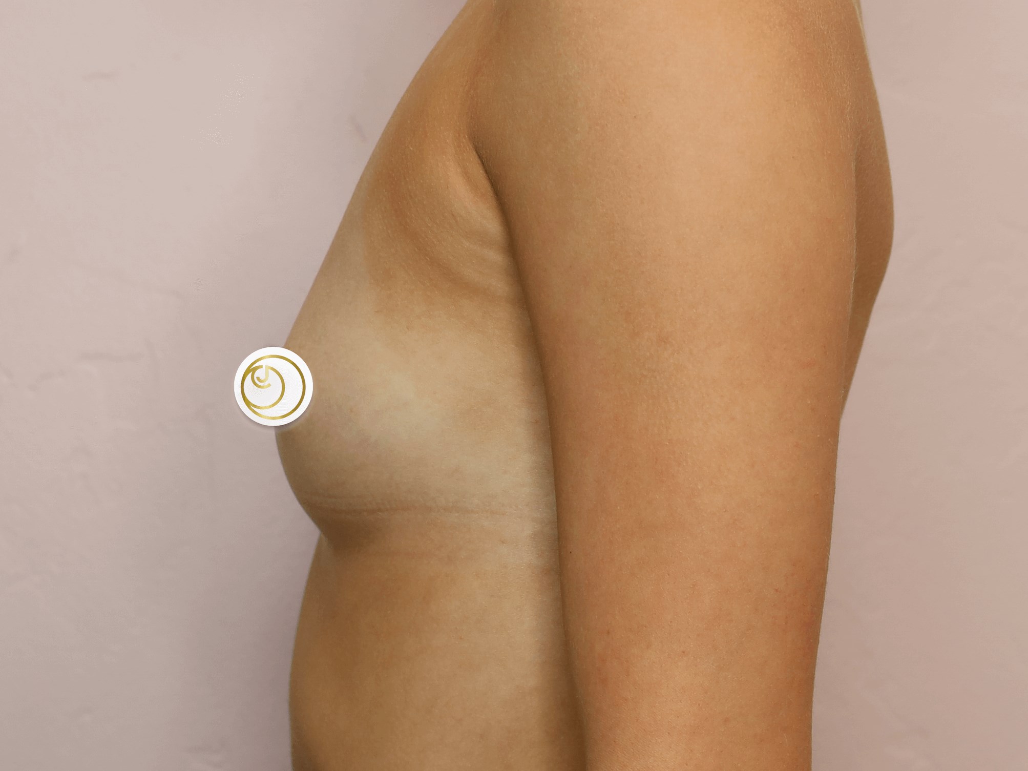 Breast Augmentation (Side) Before