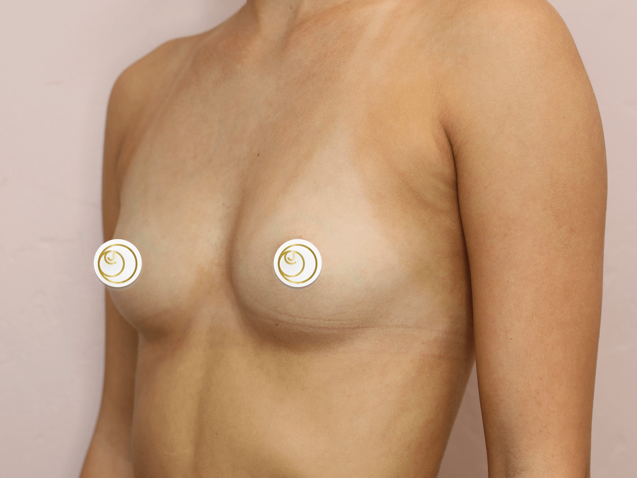 Breast Augmentation (Angle) Before