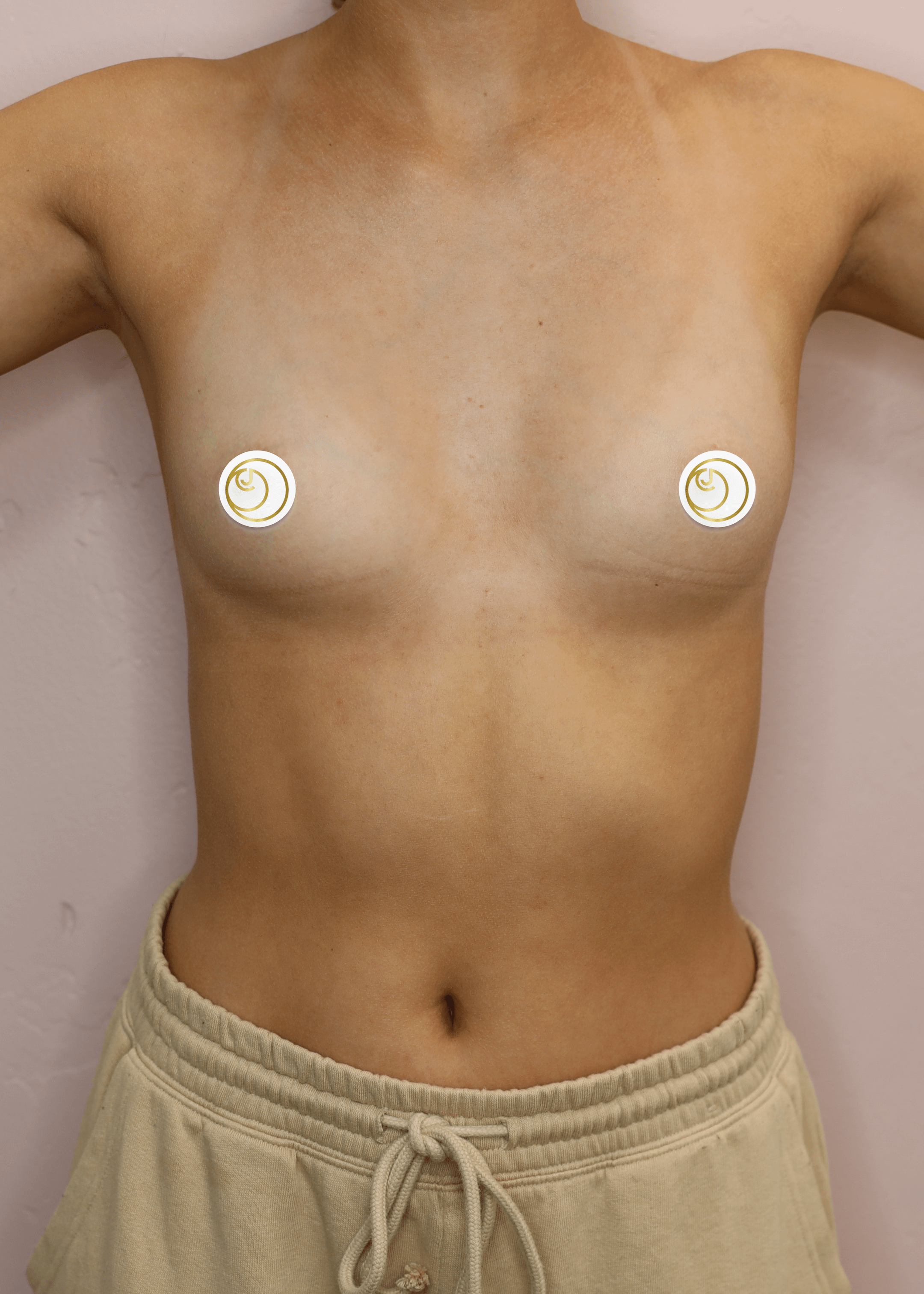 Breast Augmentation (Front) Before