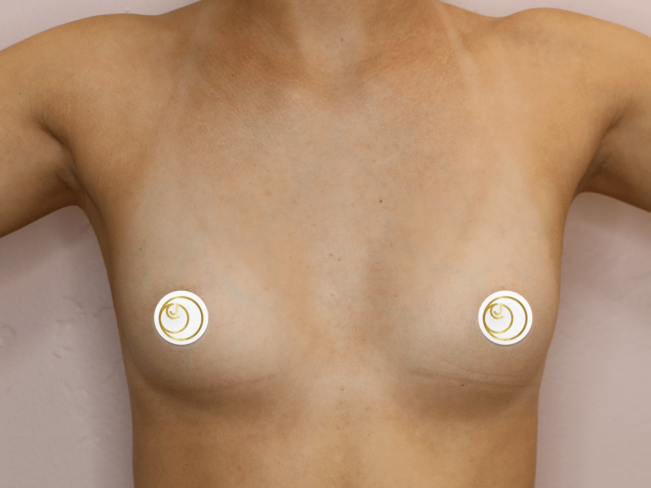 Breast Augmentation (Front) Before