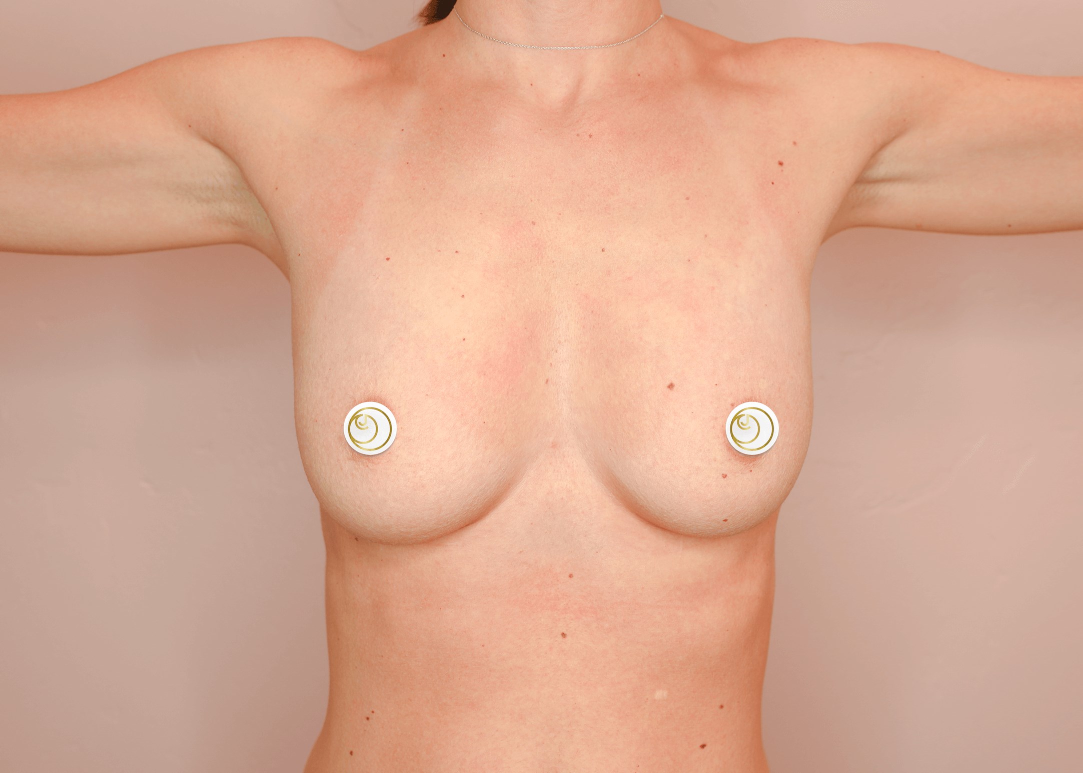Breast Augmentation (Front) Before