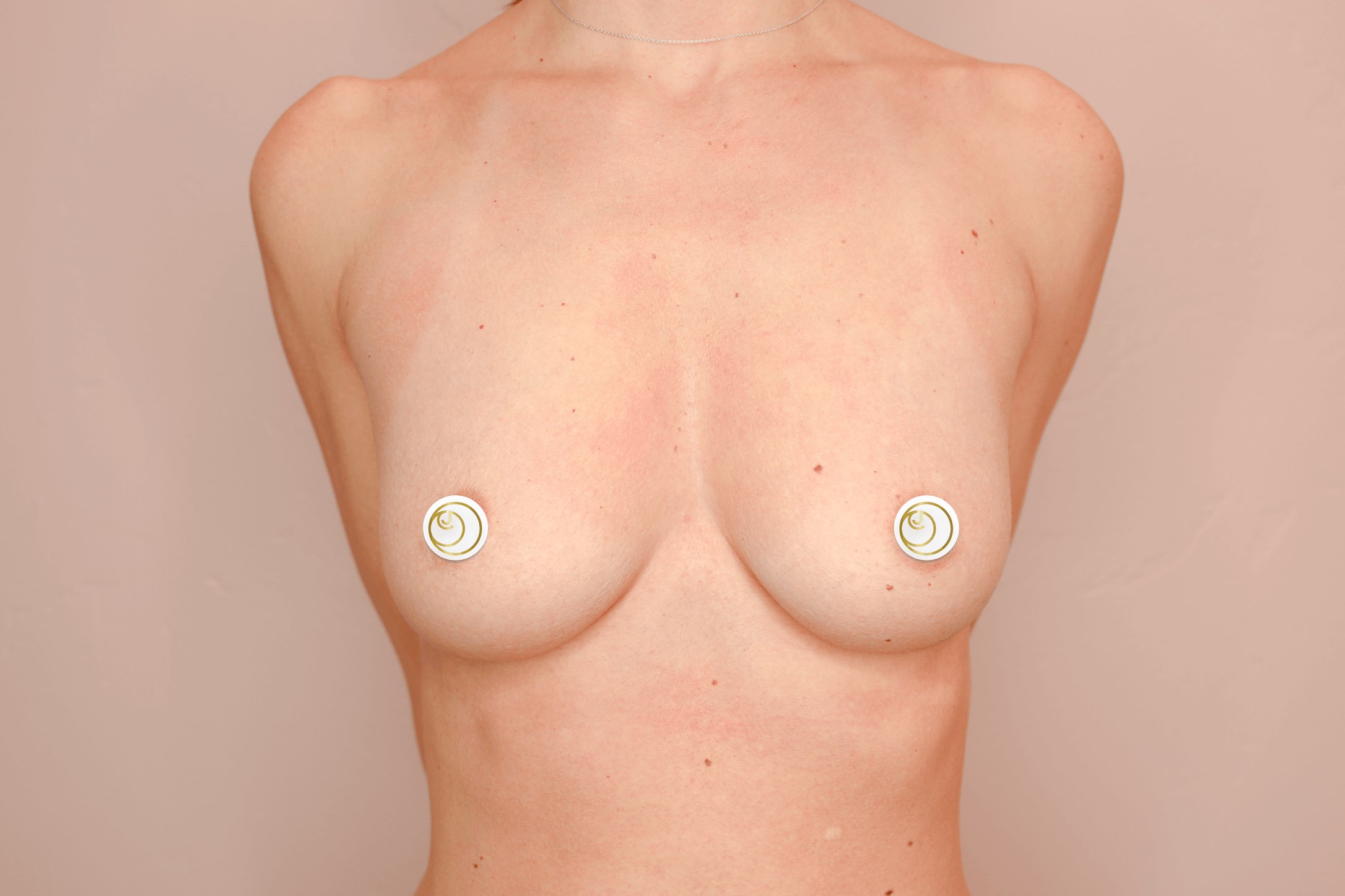 Breast Augmentation (Front) Before