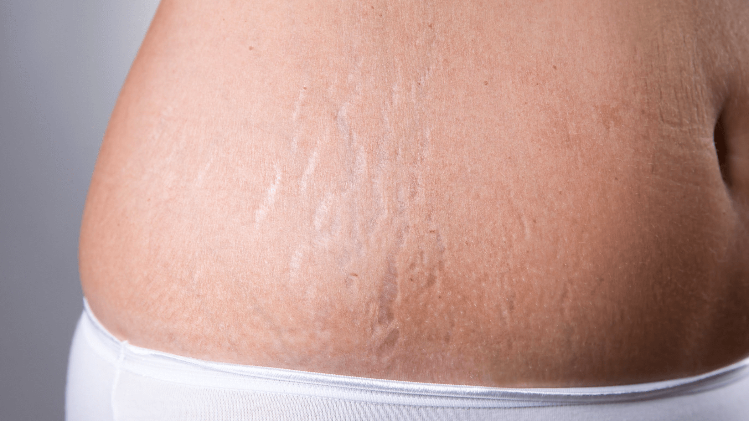 An Overweight Plus-size Woman with Stretch Marks on Her Skin