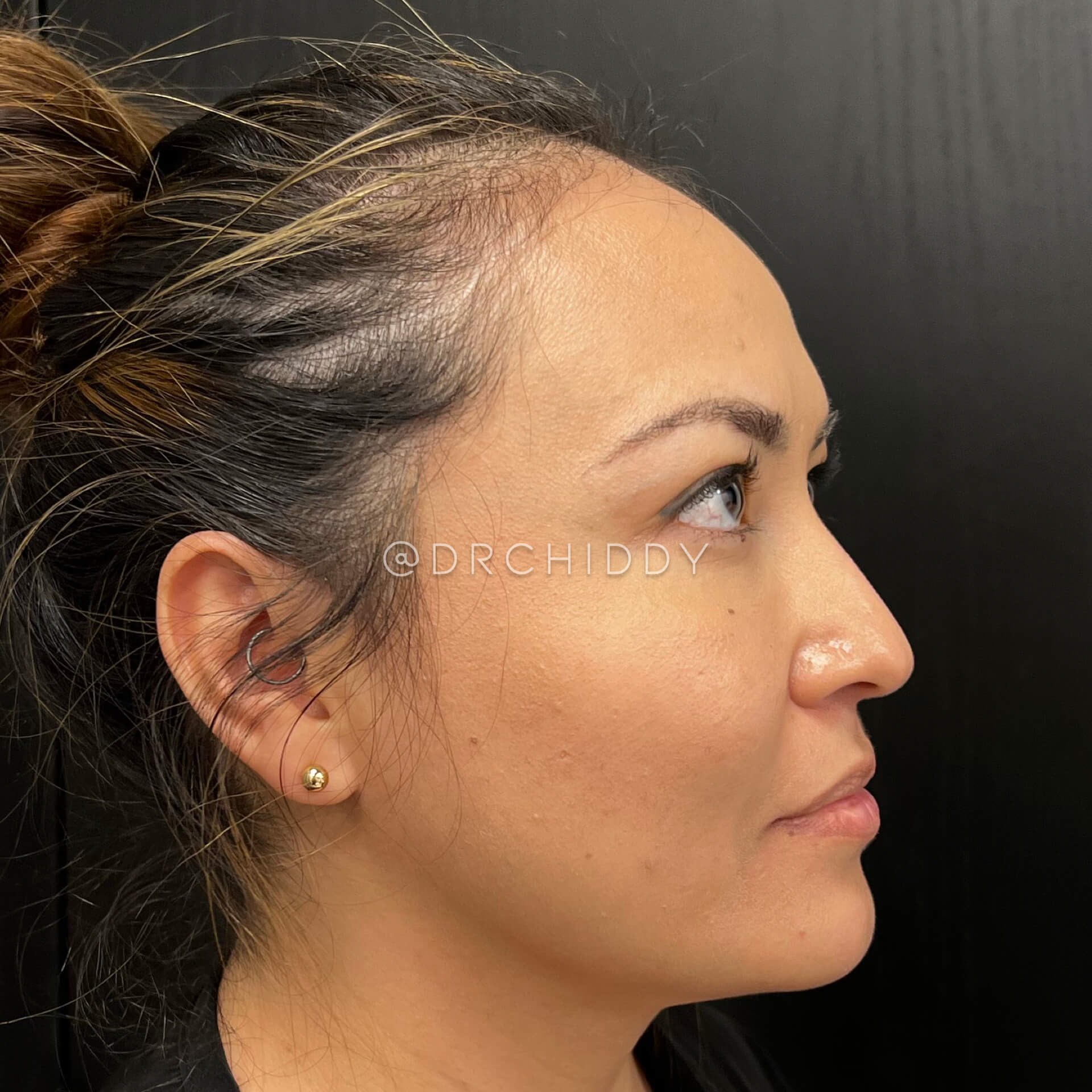 Oblique & Lateral View Before