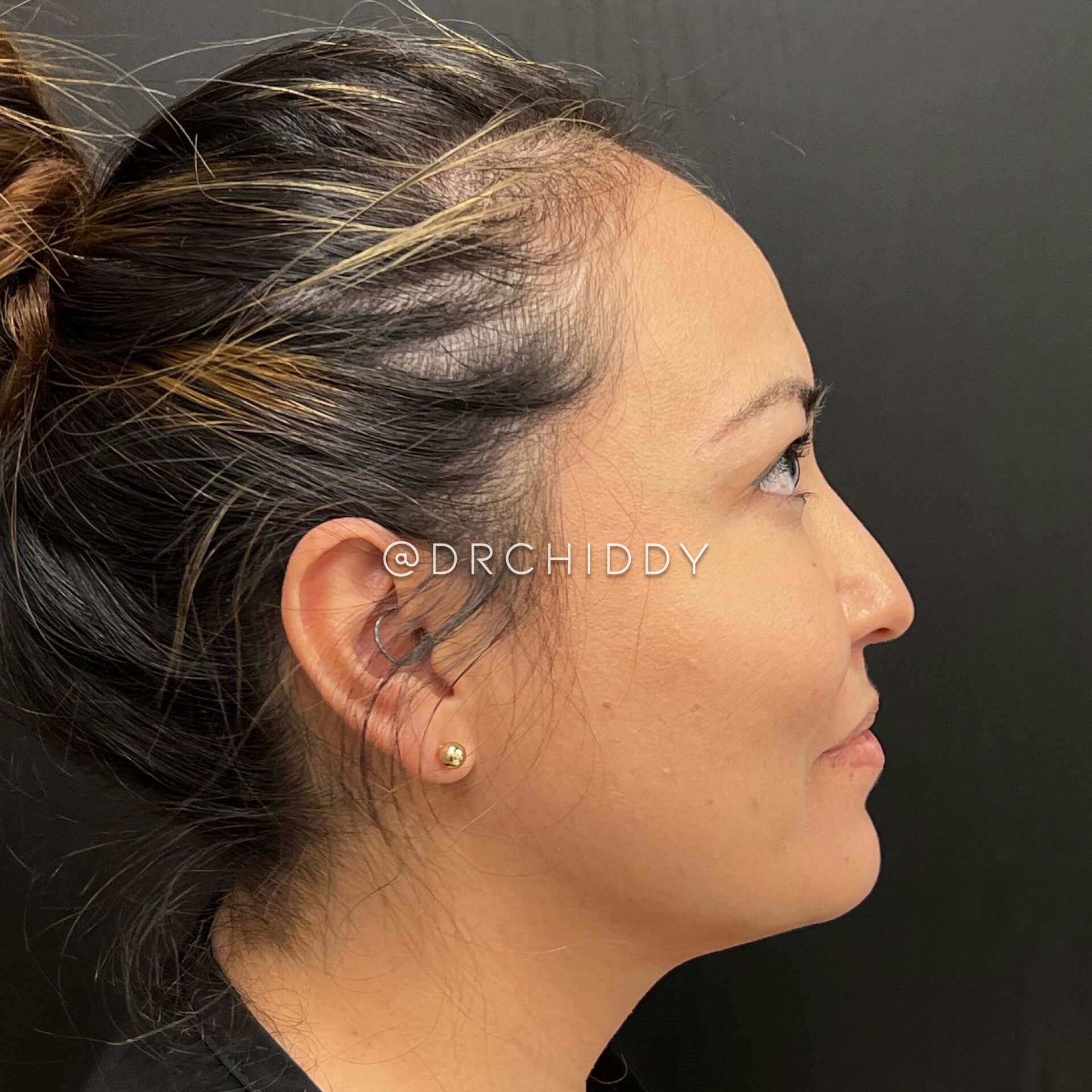 Oblique & Lateral View After