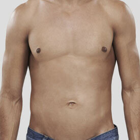 Gynecomastia Treatment